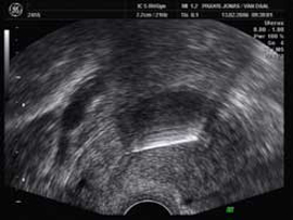 Ultraschall gebärmutter ohne schwangerschaft
